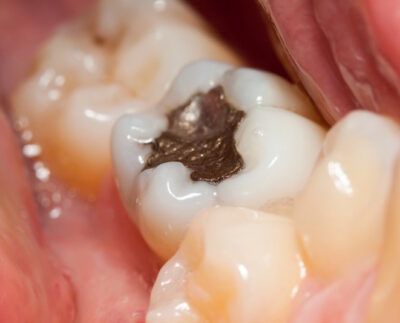 cavity-and-fillings